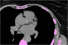 CT calcium scoring image